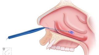 Concha Bullosa Surgery