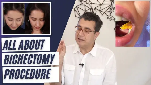 All About Bichectomy Procedure video